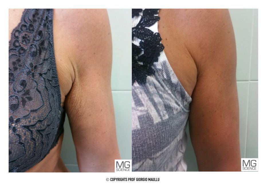 ATTIVA Underarm/ Arm Treatment